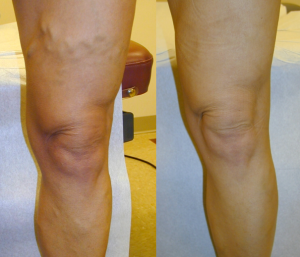 Before and after vein removal