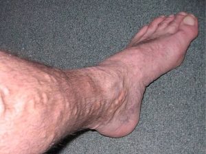 VARICOSE VEINS: DEFINITION, CAUSES AND TREATMENT