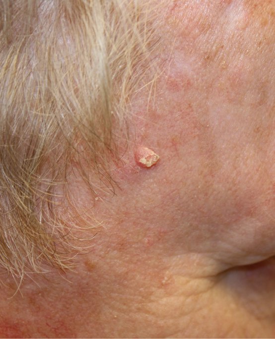 Red Spots on Skin - HubPages