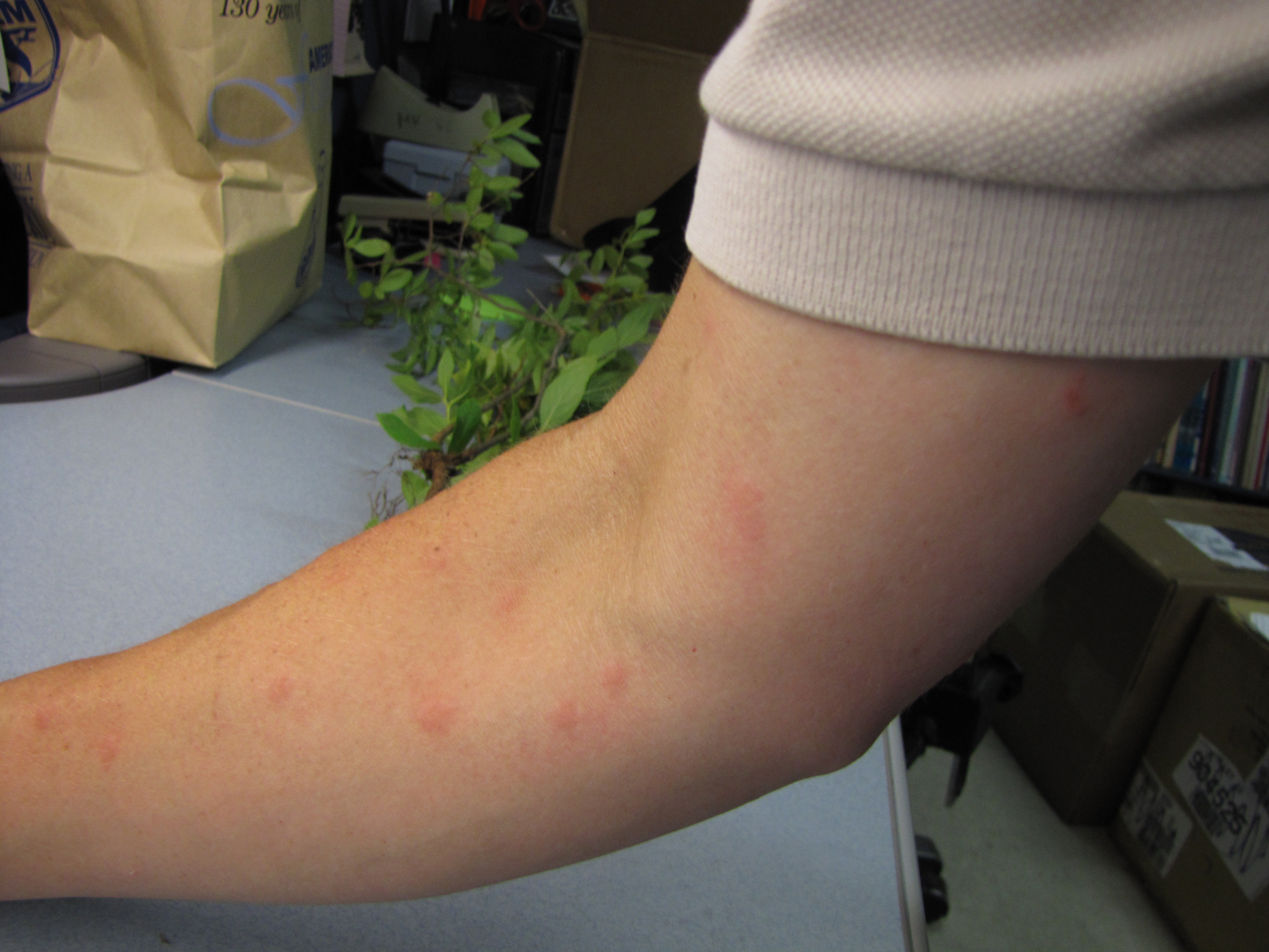 21 Common Red Spots on Universal Dermatology