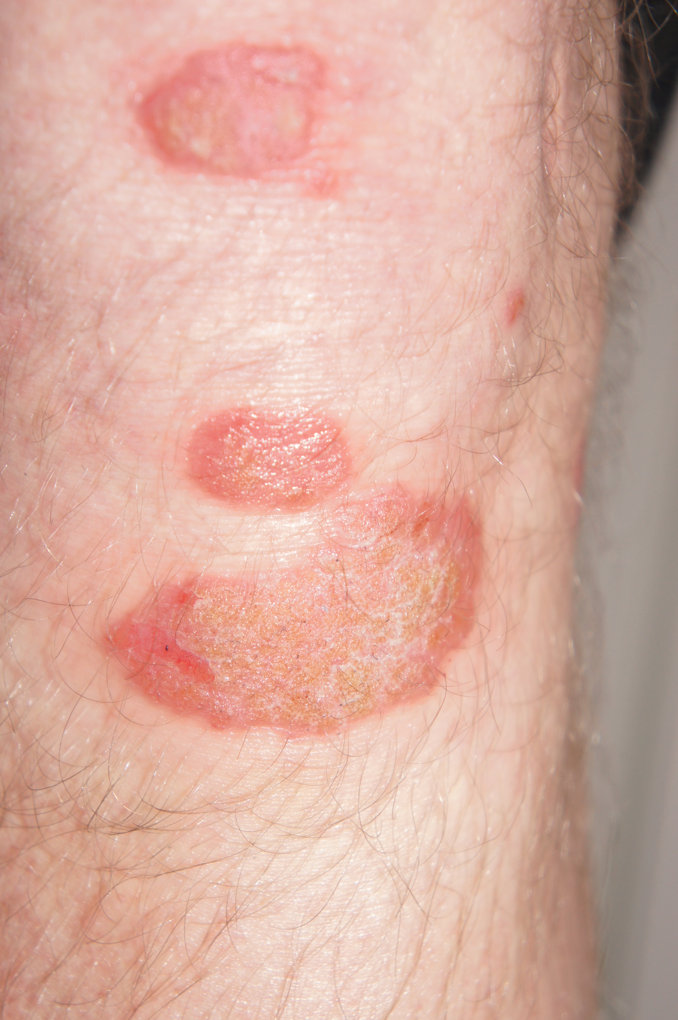 pinpoint red spots on the skin methotrexate
