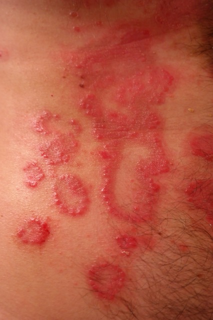 Identifying 21 Common Red Spots on Skin - Dermatology