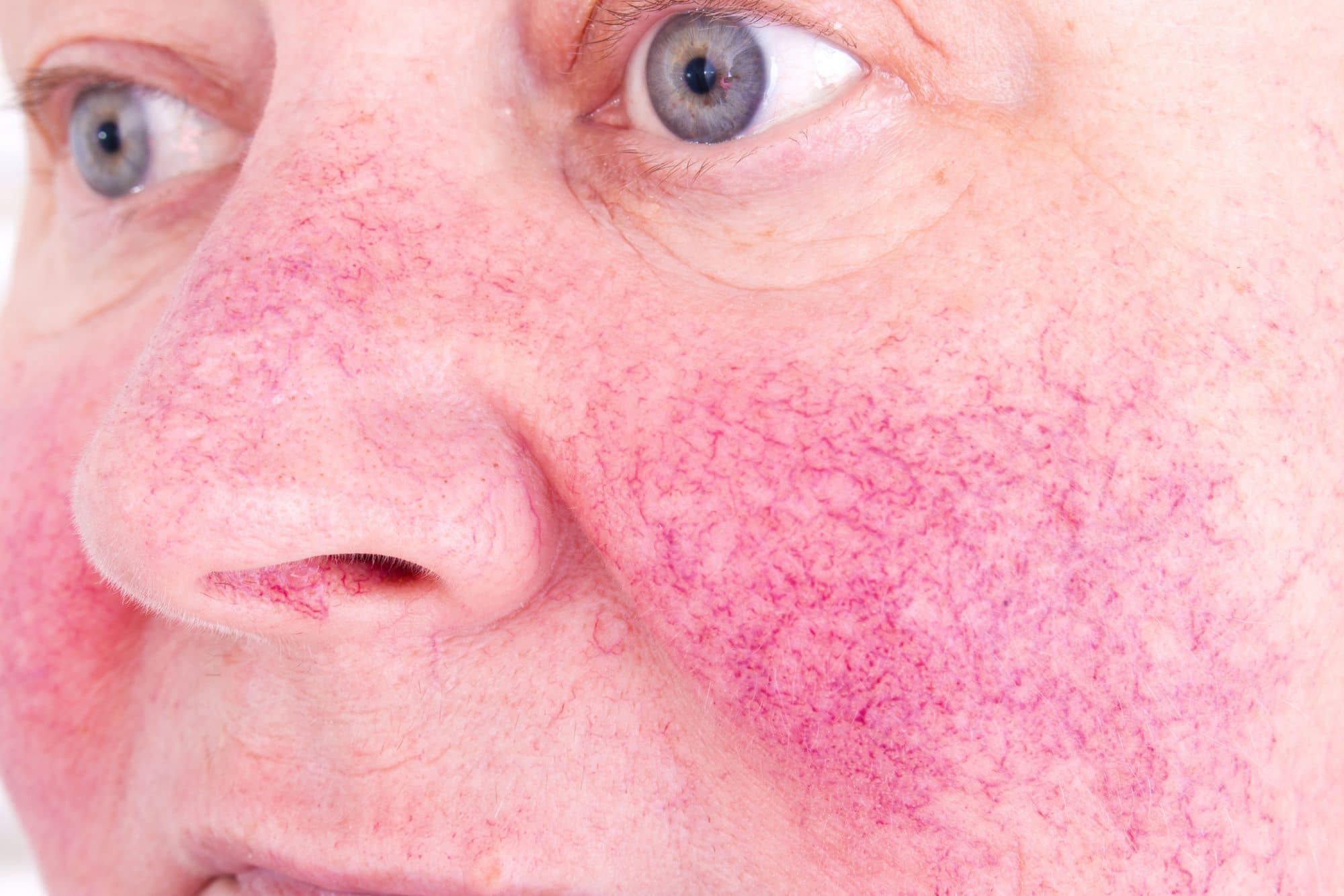 Identifying 21 Common Red Spots on Skin - Dermatology