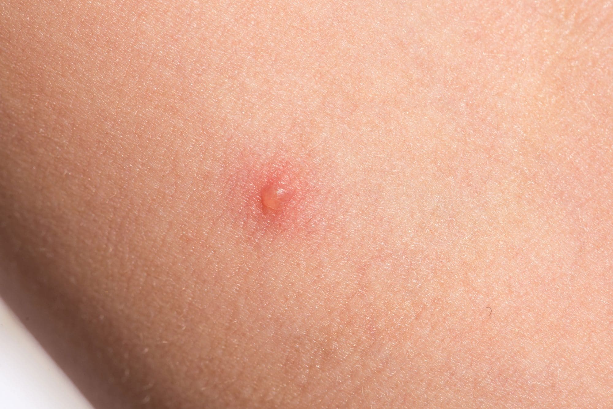 diagnosing-skin-bumps-lumps-blisters-bug-bites