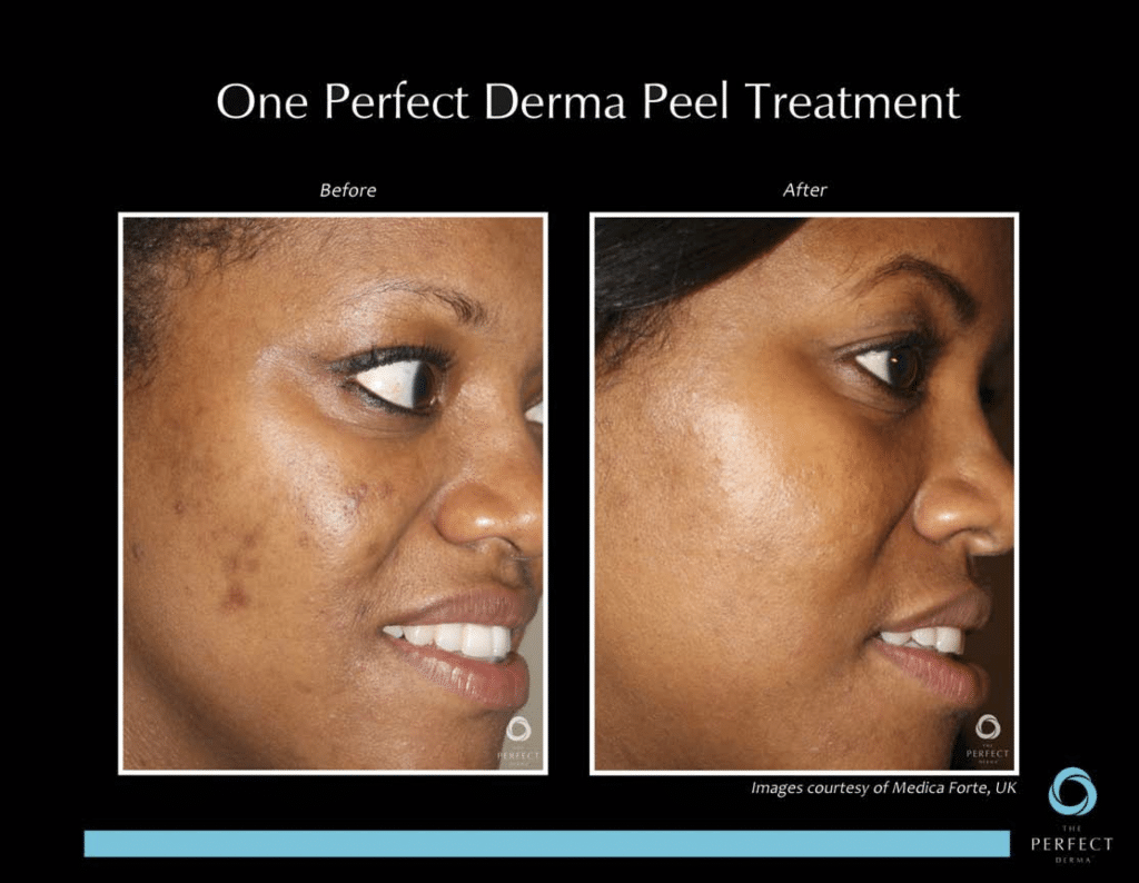 Professional Chemical Peels | Chemical Peel Treatments