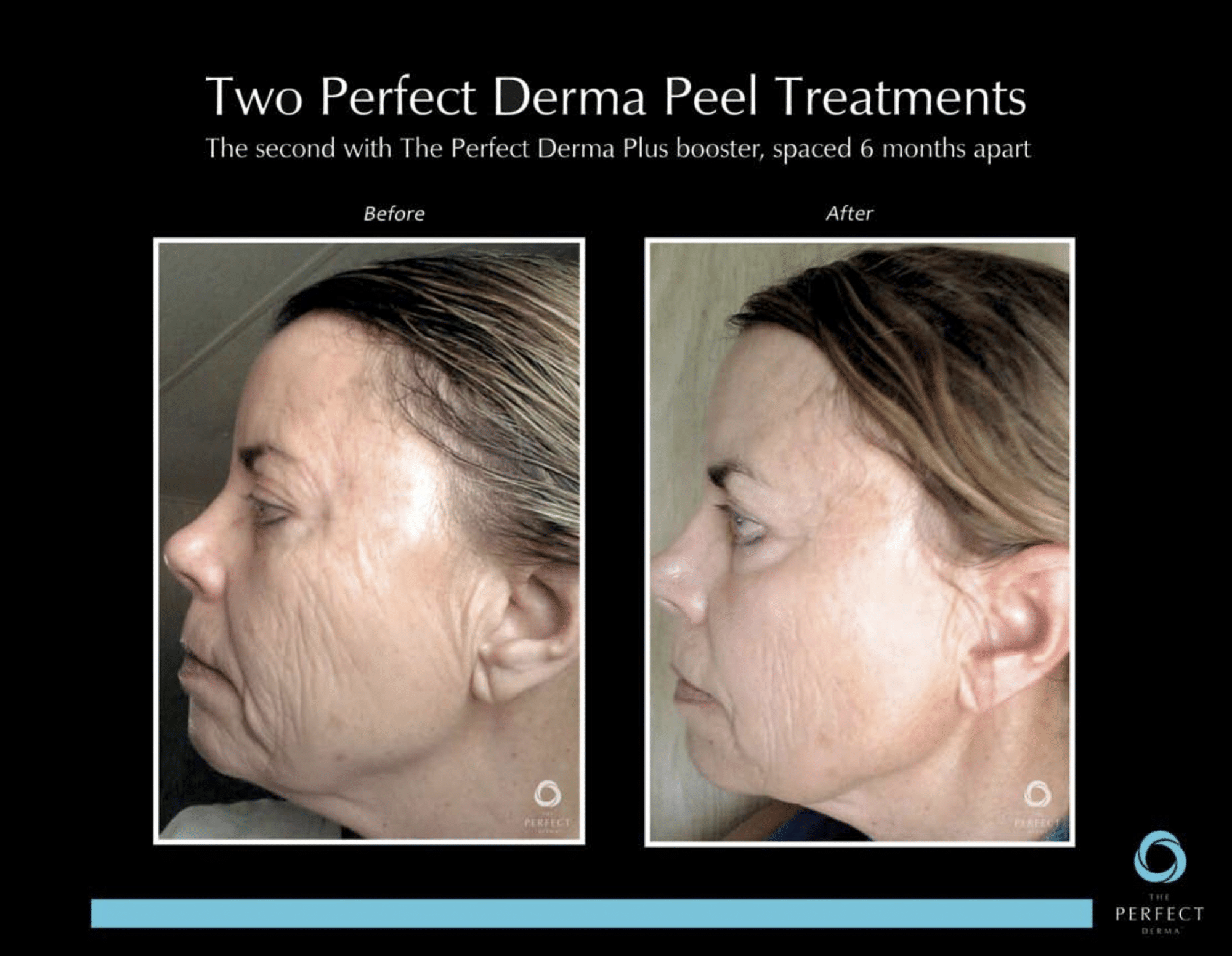 Before & After derma peel