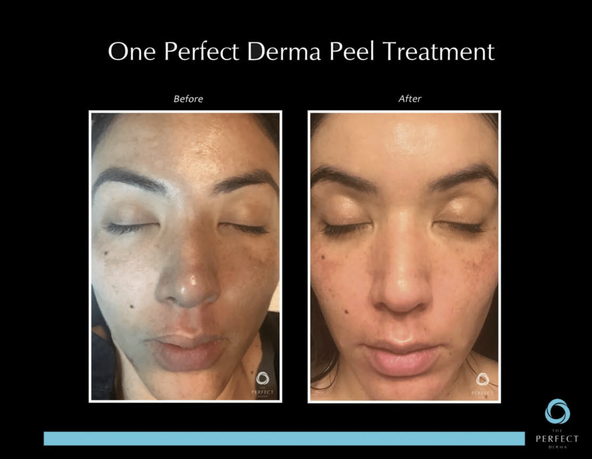 Before & After Derama Peel